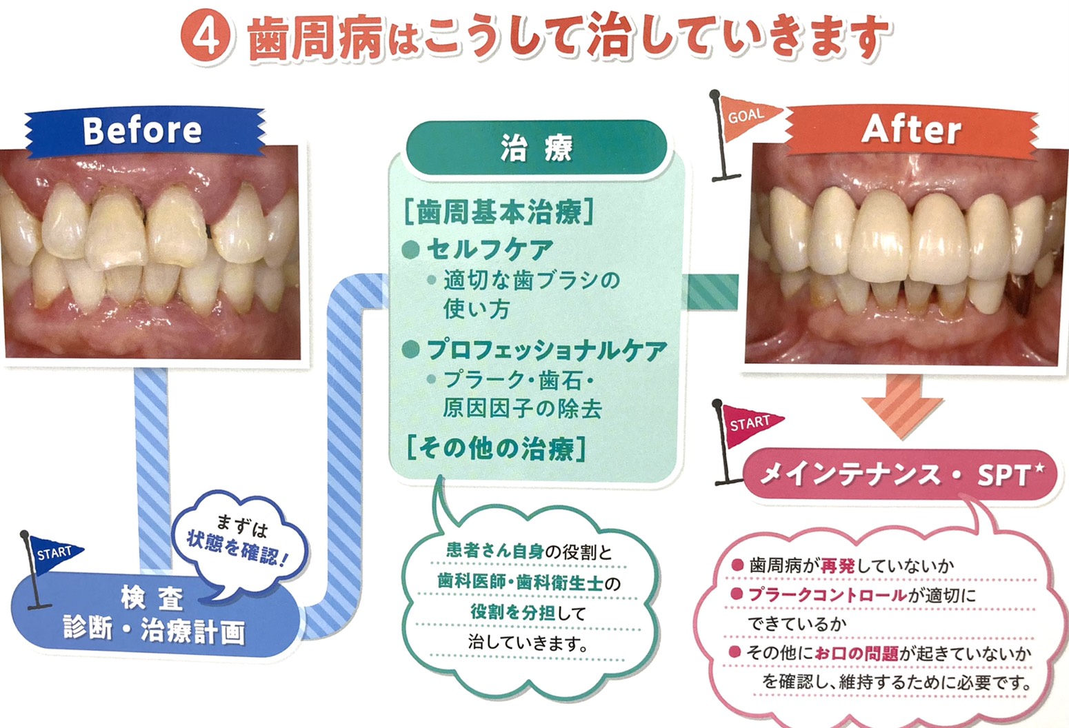 歯周病について その②