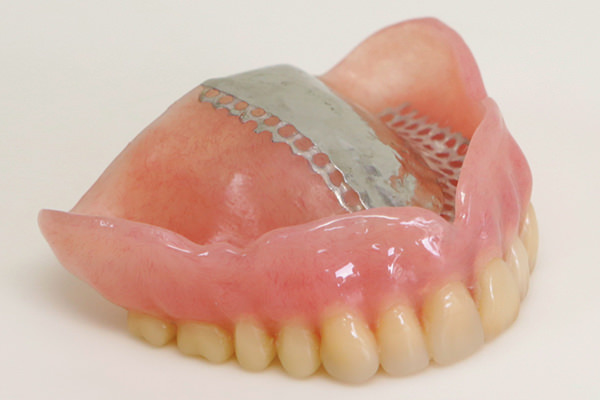プラスチックの入れ歯(保険の入れ歯)